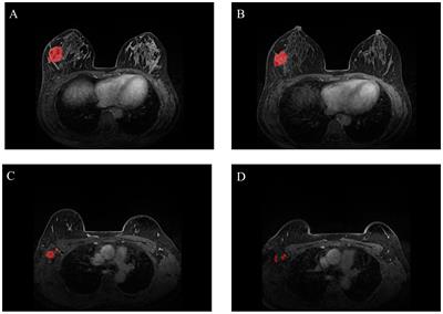 Radiomic model based on magnetic resonance imaging for predicting pathological complete response after neoadjuvant chemotherapy in breast cancer patients